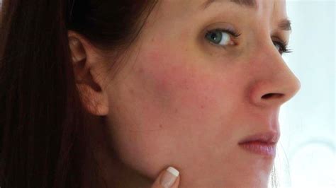 How To Reduce Facial Redness Howcast