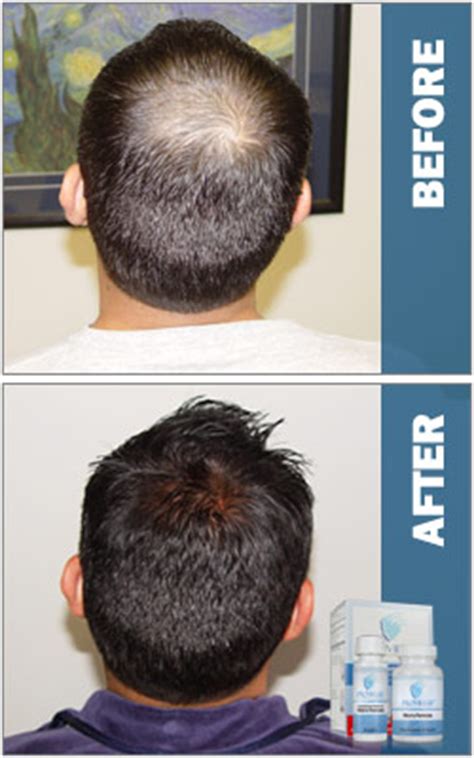 Deficiency​ of this vitamin can lead to hair fall, poor skin health and other health problems. Biotin Hair Growth: Biotin Hair Growth For Men Pattern ...