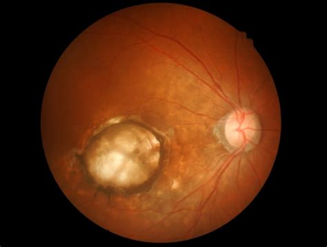 How Could Intravitreal Vegf Target Wet Age Related Macular Degeneration