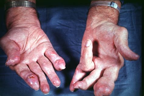 Gout Physical Examination Wikidoc
