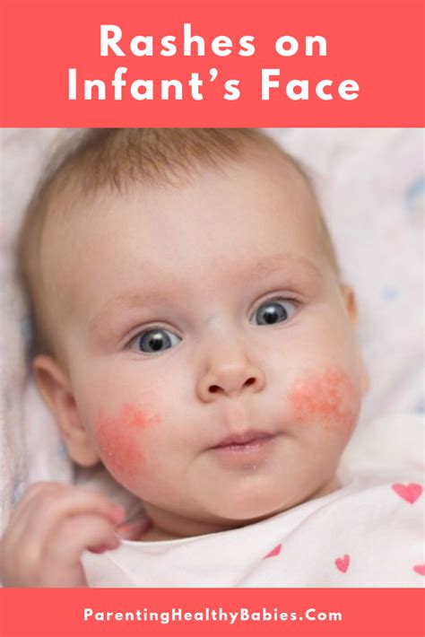 11 Effective Home Remedies For Treating Rashes On Infants Face Rash