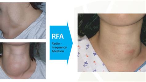 Hifu Focused Ultrasound Ablation Thyroid Nodules Thyroid Center Of