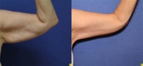 Upper Arm Lift Before And After Photos Patient 278 Ypsilanti Mi