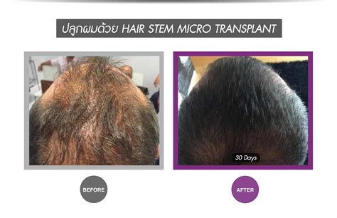 Hair loss research is breaking new ground, as more and more people are interested in this area of development. Breakthrough Stem Cell Treatment for Hair Loss - Apex ...