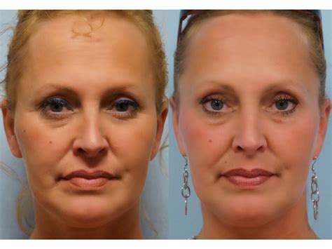 Maybe you would like to learn more about one of these? Facial Plastic Surgery: Botox browlift, Nonsurgical ...