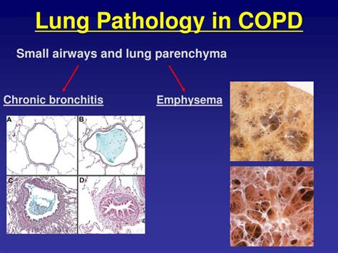 Once lung scarring occurs, it's generally irreversible. PPT - Dr. Danny Galdermans Dept Respiratory Medicine ZNA ...