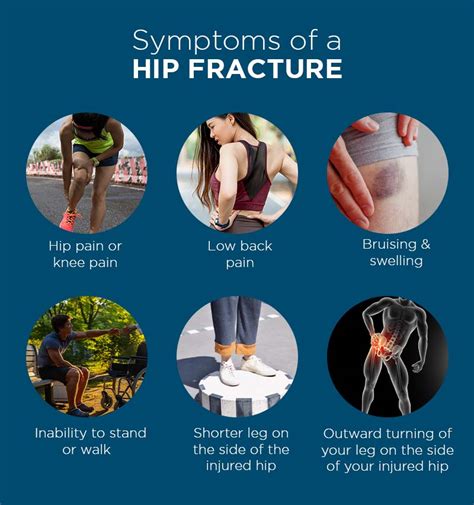 What Are The Signs And Symptoms Of A Hip Fracture Aprofessor Andrew Dutton