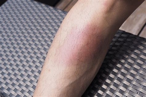 Swollen Bruise On Shin