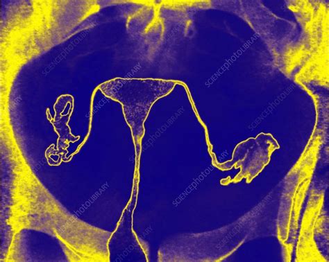 Female Reproductive System Hysterography Stock Image C0270985