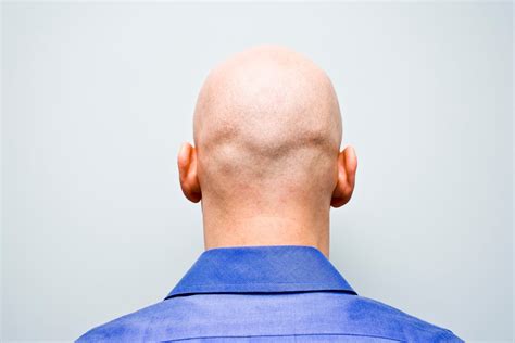 Calling Man ‘bald Is Sex Related Harassment Employment Tribunal Rules The Independent