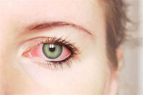 Sindrome Dell Occhio Secco Centro Polispecialistico Solivo