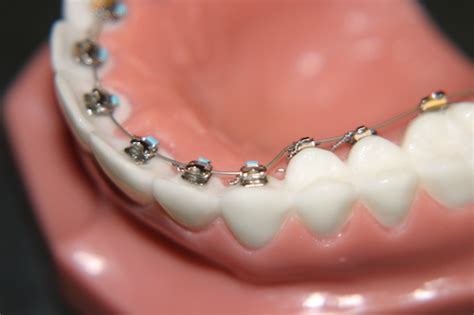 How Do Braces Work A Step By Step Insight Into Teeth Straightening