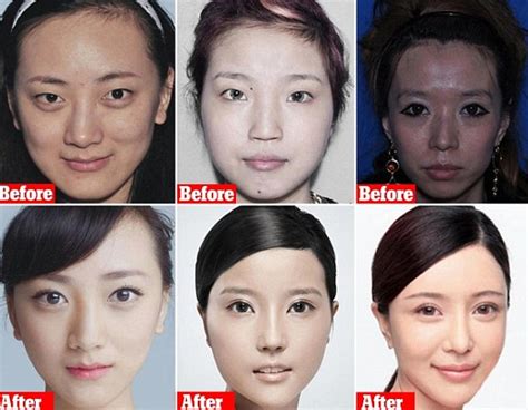 Chinese Plastic Surgery Before And After