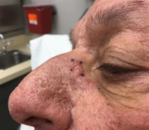 Clinical Challenge Nonhealing Growth On Nose Mpr