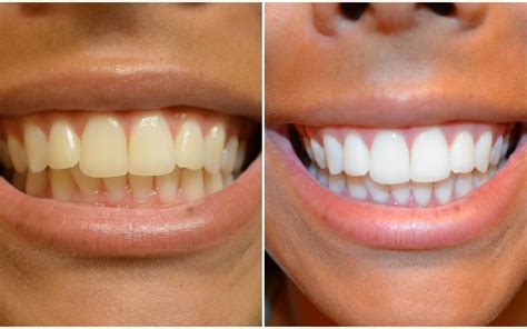 Are Teeth Whitening Strips Effective? | New Jersey Orthodontics