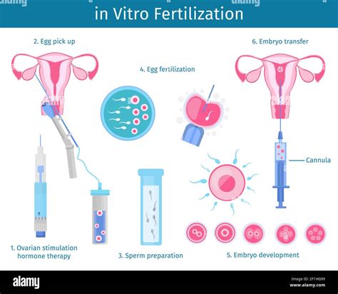 In Vitro Fertilization Process Concept With Steps Of Insemination