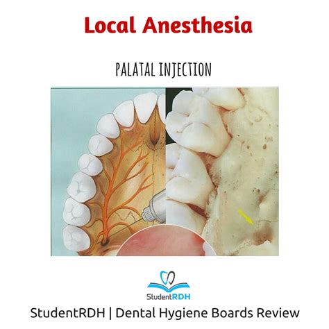 Which Injection Anesthetizes The Palatal Tissues Around The Left