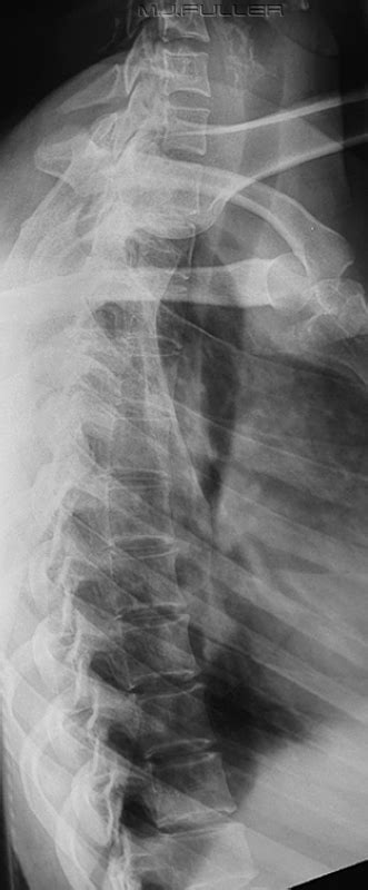 Modified Lateral Thoracic Spine Technique Wikiradiography