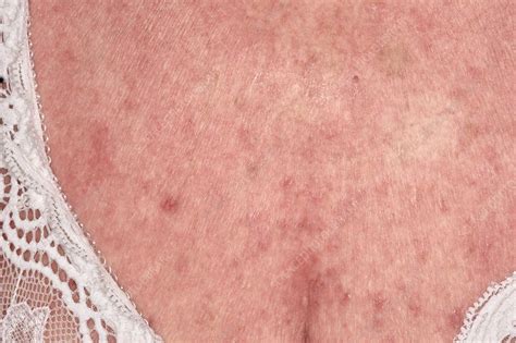 Erythrodermic Psoriasis Stock Image C0426399 Science Photo Library