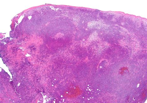 Pathology Outlines Primary Cutaneous Cd8 Aggressive Epidermotropic T