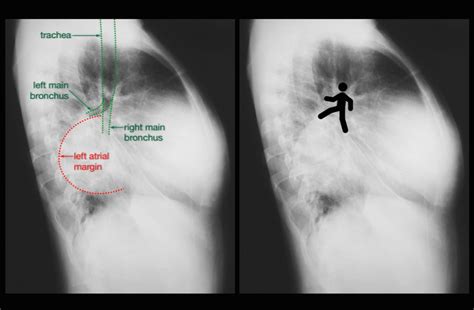 Left Atrial Enlargement Due To Mitral Valve Regurgitation Radiology