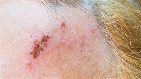 Shingles Symptoms Early Stages