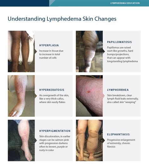Understanding Lymphedema Skin Changes Tactile Medical