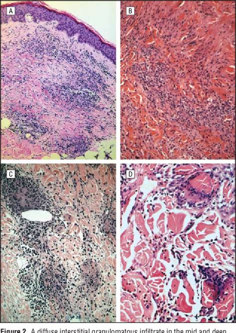 Pdf Interstitial Granulomatous Dermatitis Associated With The Use Of