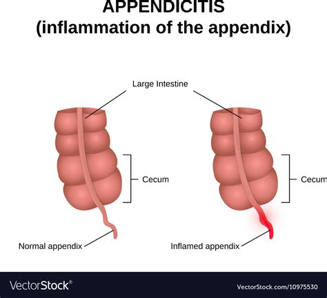 Inflammation Appendix Royalty Free Vector Image