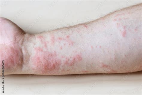 Sample Of Allergic Contact Dermatitis Itchy Rash On Side Of Forearm