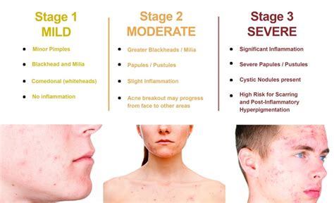 What Is Moderate Acne Health Life Media