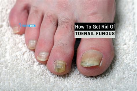 5 Super Effective Ways For How To Get Rid Of Toenail Fungus Naturally