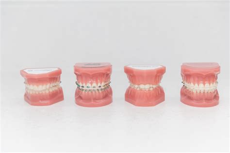 Clear Ceramic Braces Reading Tooth Coloured Braces