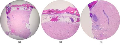 Cureus Histopathological Coexistence Of Extragenital Lichen Sclerosus