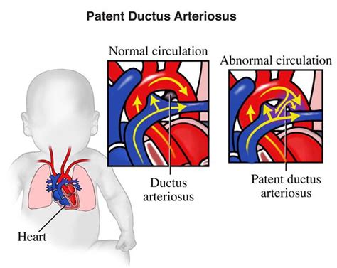 Patent Ductus Arteriosus Treatment In New Jersey Heart Care