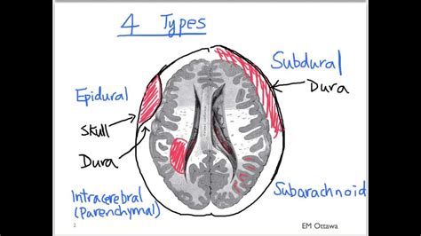 Sdh can happen in any age. Intracranial Bleed - Part 1 - YouTube