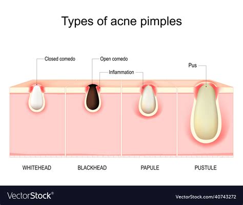 Types Of Acne Pimples Cross Section Of Human Skin Vector Image