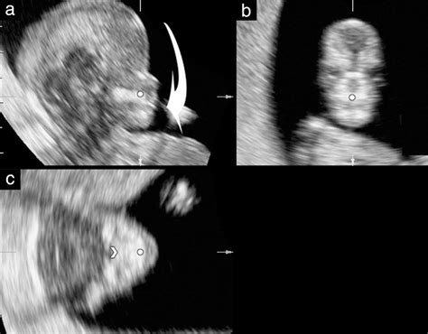 First‐trimester Diagnosis Of Cleft Lip And Palate Using Three