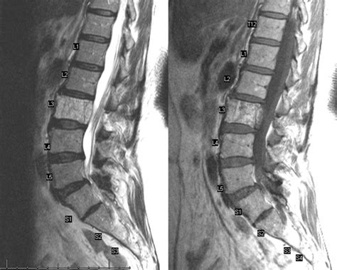 Spinal Hemangioma Pre Embo Mri Png Mri Mri Scan Magnetic Resonance