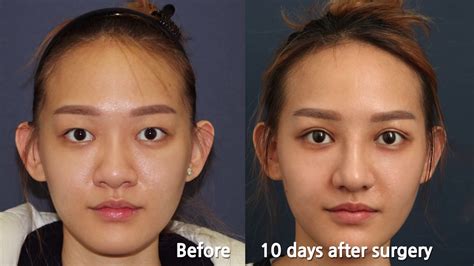 Double Eyelid Surgery In Korea Singaporean Has Eye And Nose Surgery At