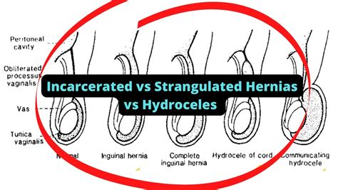 Incarcerated Vs Strangulated Hernias Vs Hydroceles Youtube