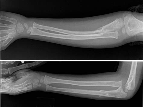 Forearm Injury In A 5 Year Old Boy The Bmj
