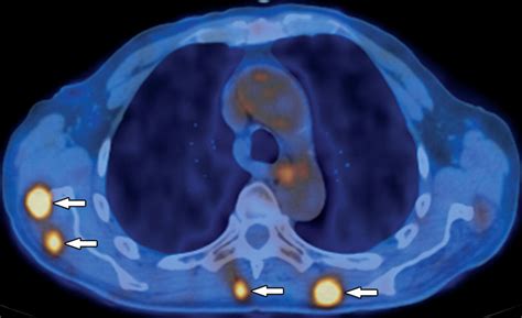 Petct Of Esophageal Cancer Its Role In Clinical Management