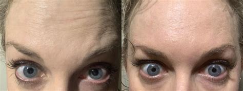Botulinum ToxinA BOTOX Dysport Before And After Pictures Case 50