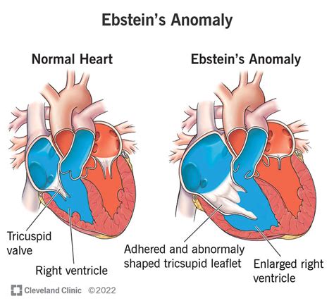 Ebsteins Anomaly Causes Symptoms Treatment