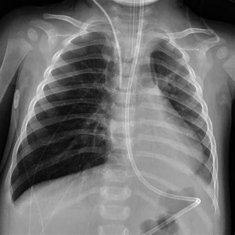 Ct Showing Hypoplastic Left Lung With Right Lung Hyperinflation And