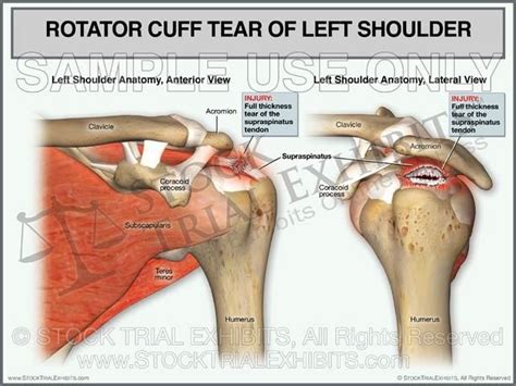 Rotator Cuff Tear Of Left Shoulder Anterior And Lateral Views Medium X Printed Trial Exhibi
