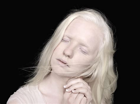 Что такое альбинизм причины и последствия