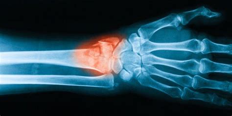 10 Facts To Know About Your Wrist Fracture Procedure ...