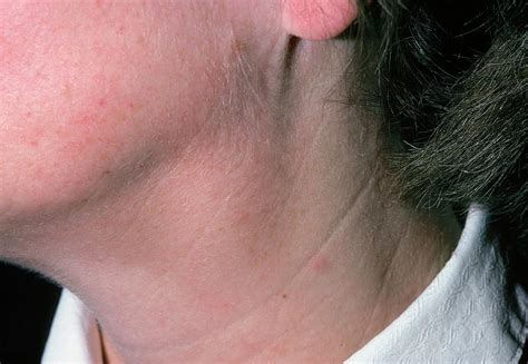 Swollen Glands Lymphadenopathy In Womans Neck Photograph By Dr P